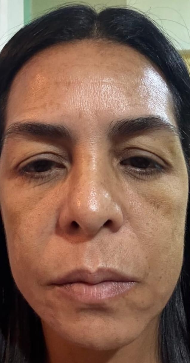 Antes